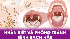 Chủ động phòng chống bệnh Bạch Hầu