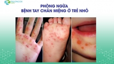Phòng ngừa bệnh tay chân miệng ở trẻ nhỏ|Bệnh viện Đa khoa Phương Chi