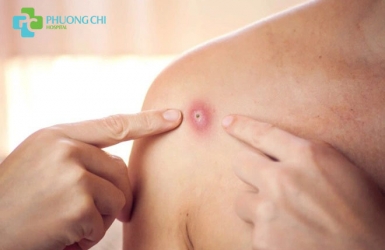 Bệnh đậu mùa khỉ: triệu chứng và cách điều trị